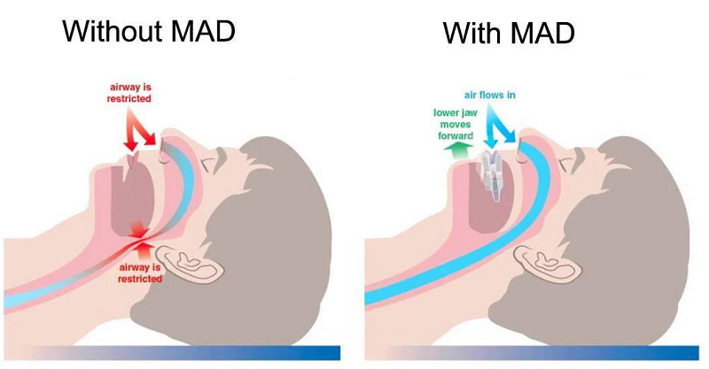 Images of before and after sleep apnea treatment
